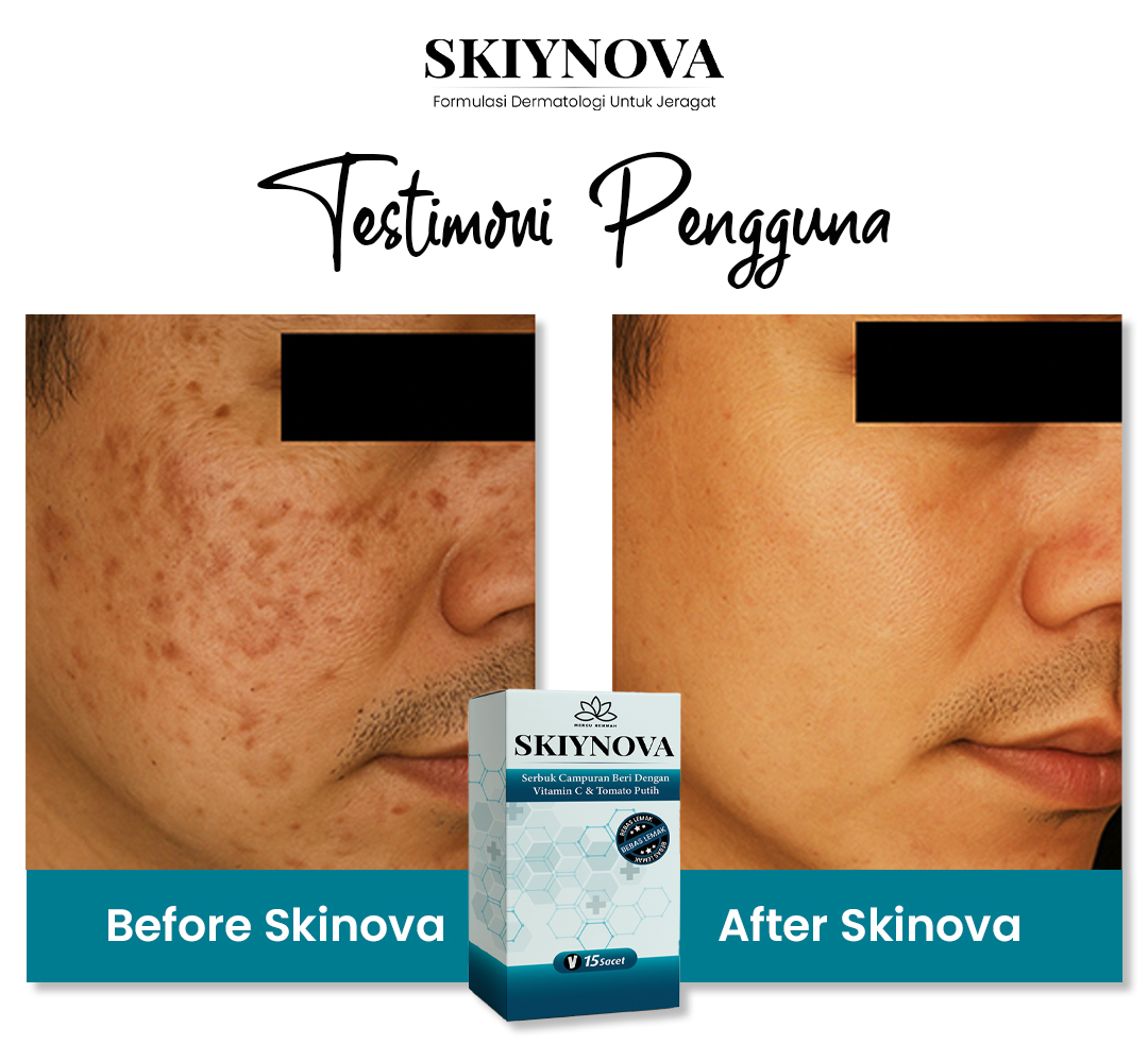 Testimoni pengguna Skiynova 3